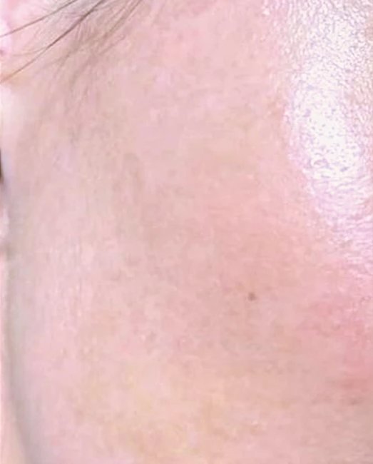 After treatment: rough skin texture