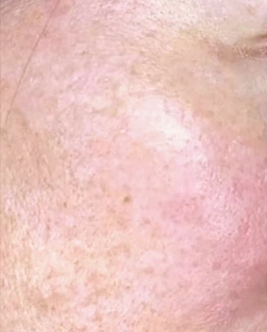 Before treatment: rough skin texture