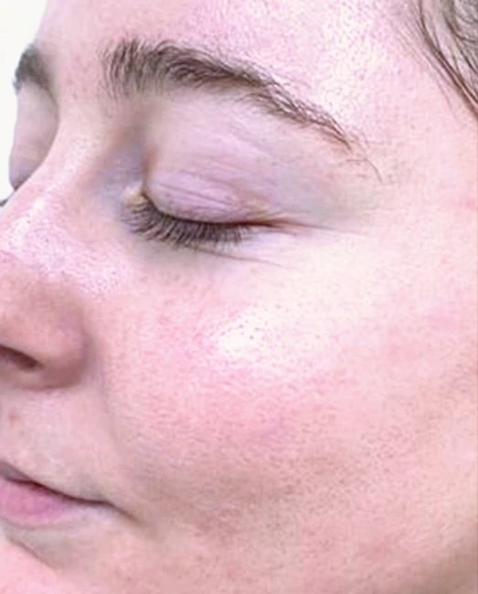 After treatment: dull, congested skin