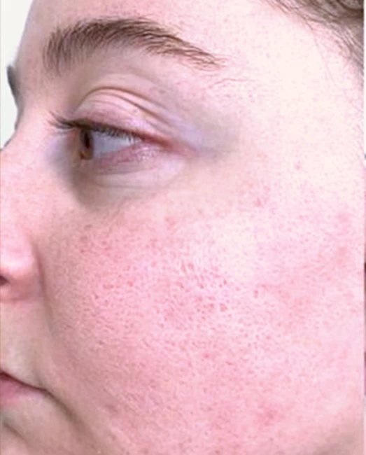 Before treatment: dull, congested skin