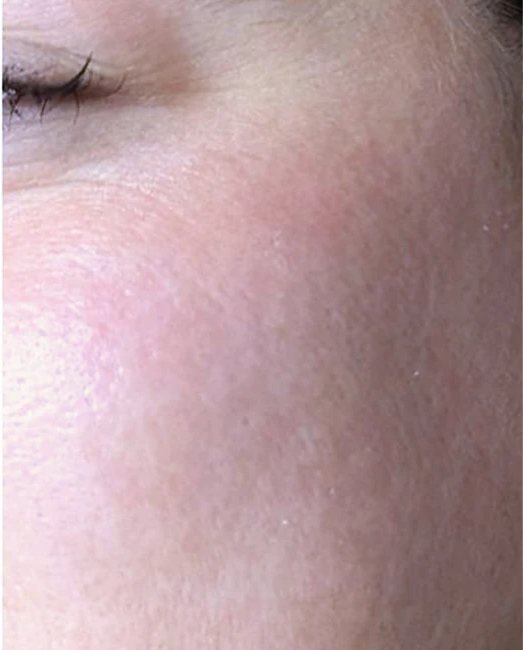 After treatment: acne marks and uneven tone