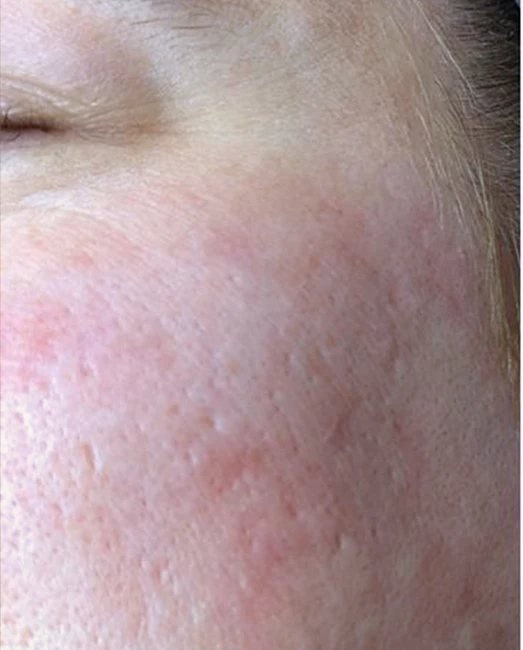 Before treatment: acne marks and uneven tone