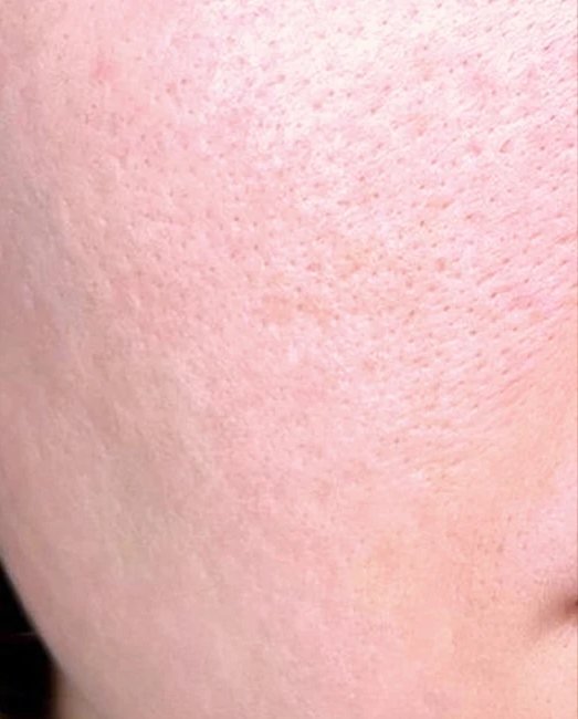 After treatment: enlarged pores and oily skin