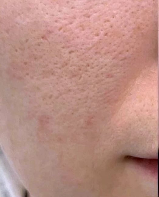 Before treatment: enlarged pores and oily skin