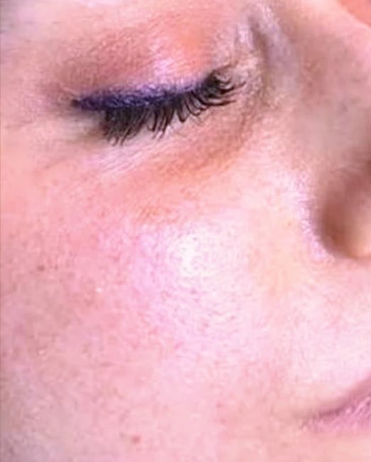 Anti-wrinkle injections for forehead and frown lines at Laser & More Clinic