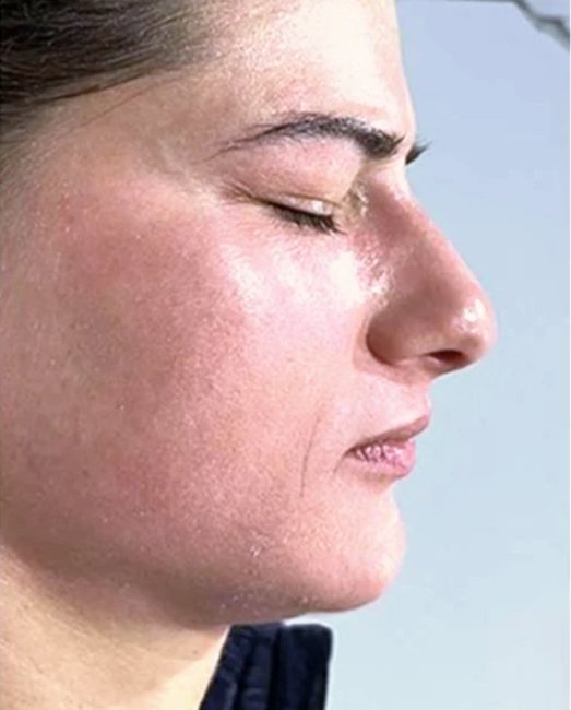 After treatment: facial pigmentation
