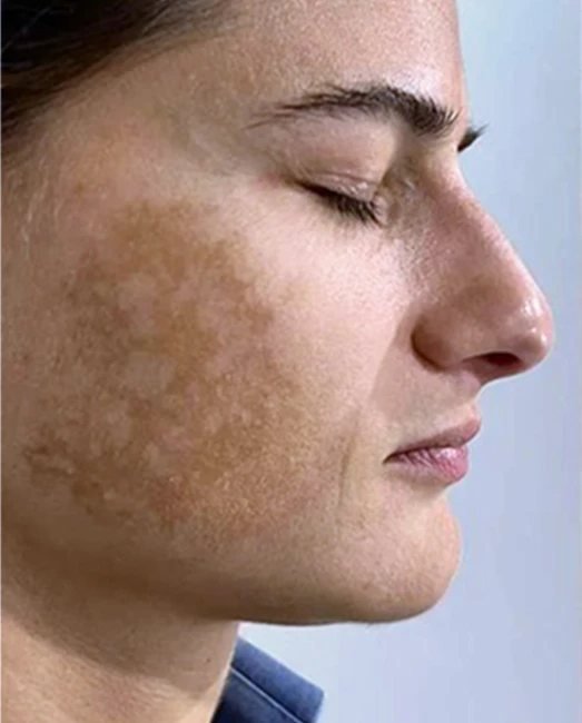 Before treatment: facial pigmentation