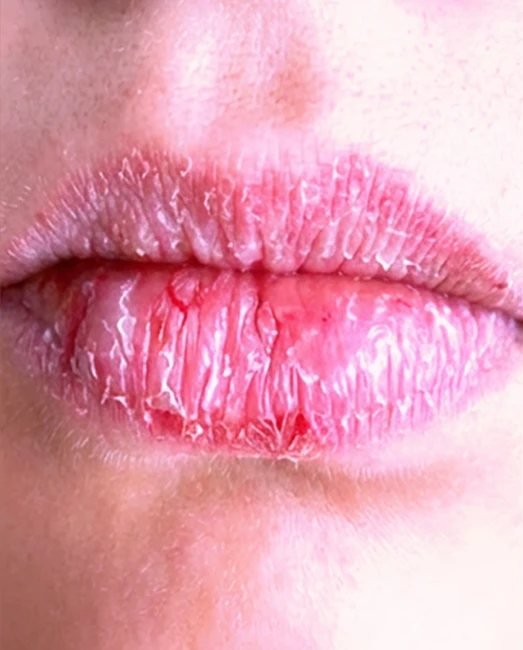 Lip filler at Laser & More Clinic