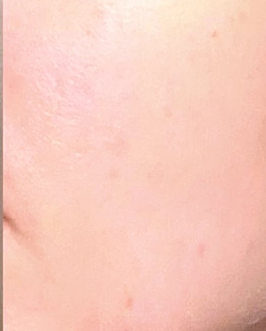 After treatment: uneven skin tone