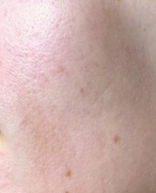 Jawline and chin fillers at Laser & More Clinic