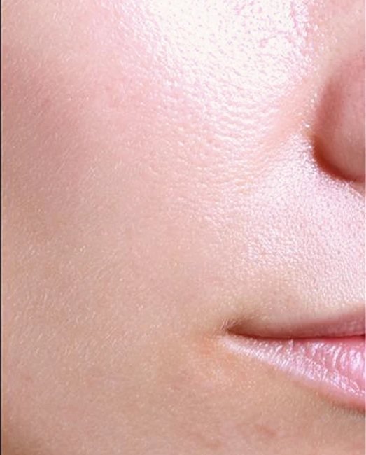 After treatment: active acne on the cheek