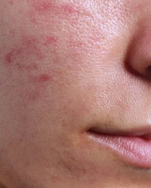 Before treatment: active acne on the cheek