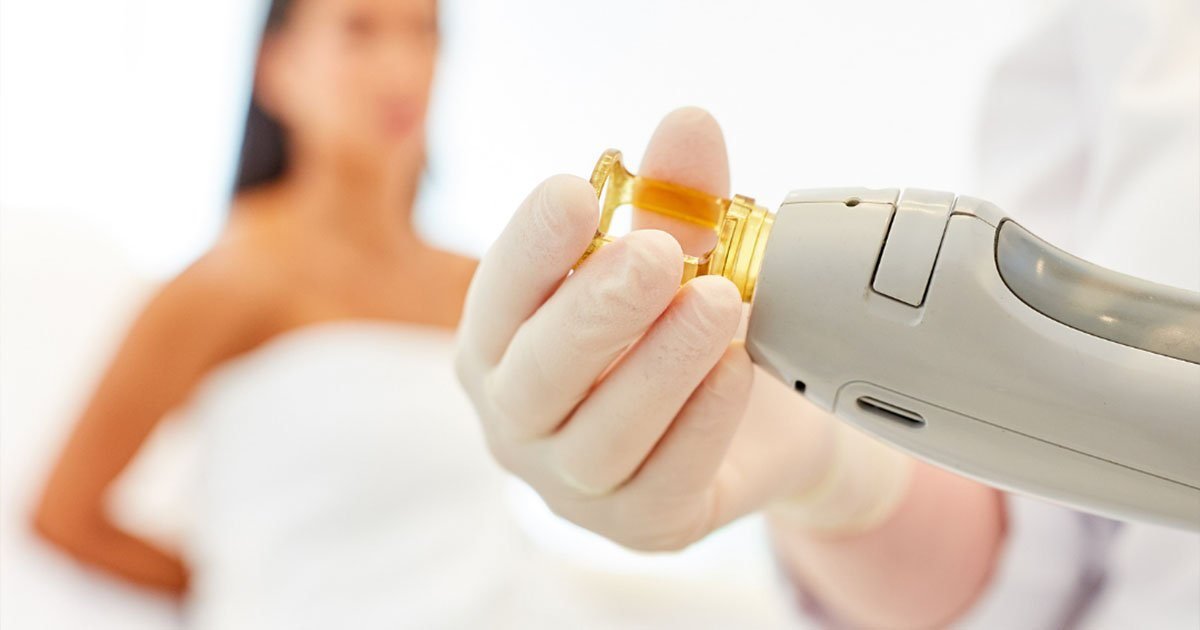 Laser hair removal treatment on the body