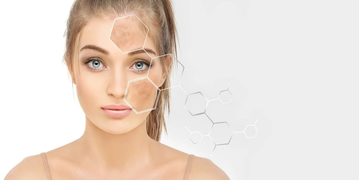 Illustration of facial pigmentation on a woman's cheek